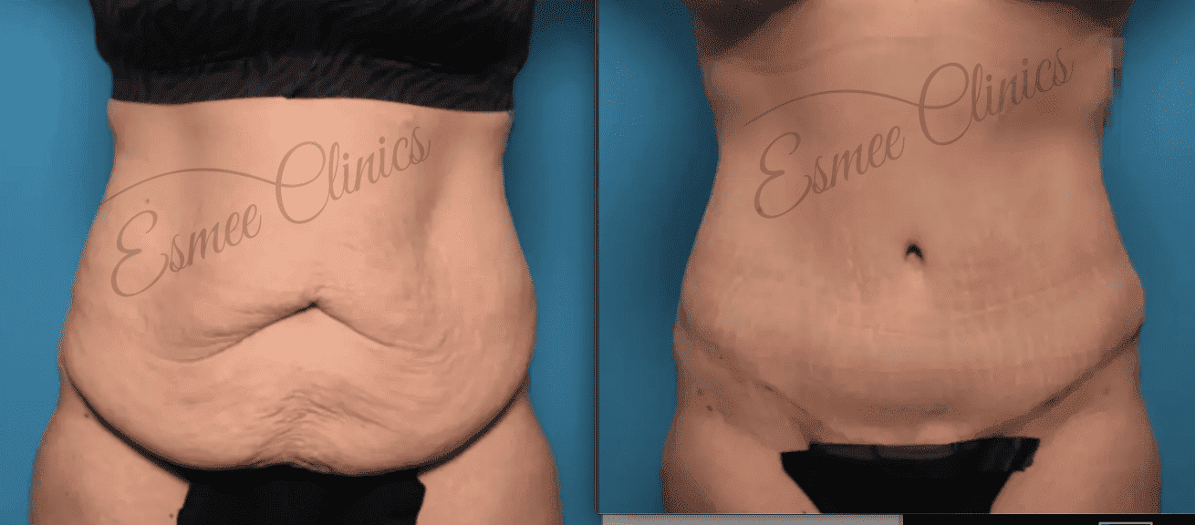 Before and After img